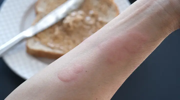 Understanding Food Allergies